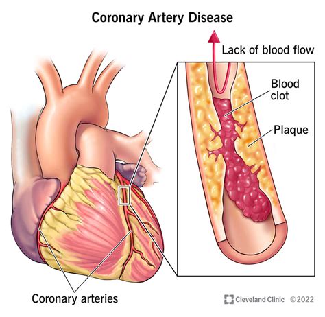 Coronary Artery Disease (CAD): Symptoms & Treatment