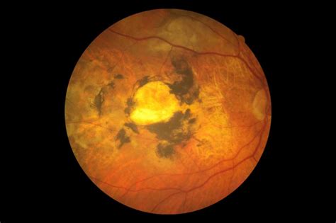 Macular Degeneration - Eyes Wide Bay