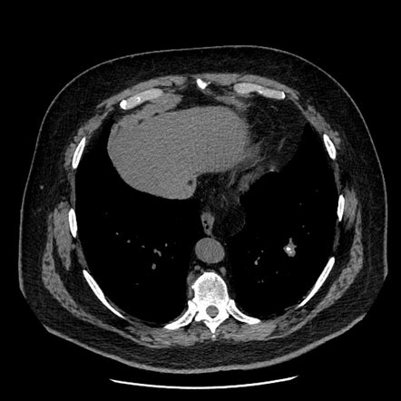 Pulmonary hamartoma | Radiology Case | Radiopaedia.org