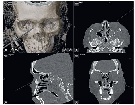 Medial Orbital Wall Fractures | Plastic Surgery Key