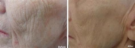 AnteAge Stem Cell Facial - Award Winning Holistic Anti-Aging Treatment Ottawa