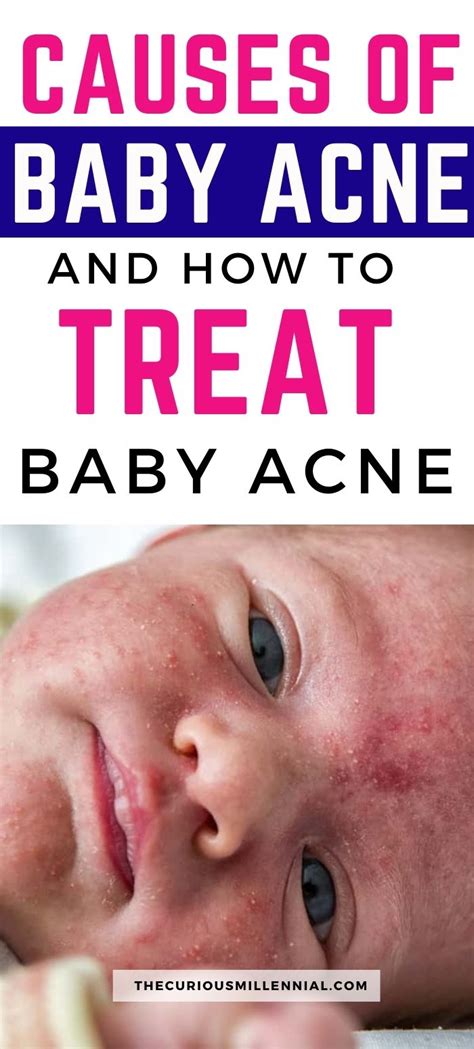 Baby Acne: Causes, Symptoms, And Treatment - The Curious Millennial