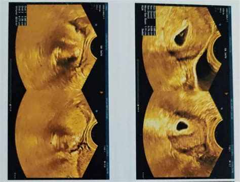 Case Study: Dermoid Cyst Removal