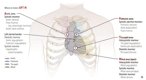 Aortic Stenosis Murmur