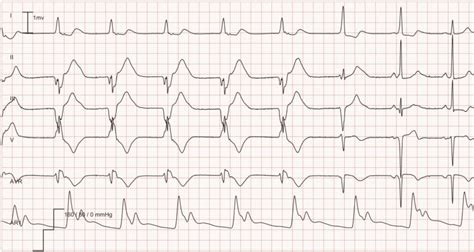 ECG Example: Idioventricular rhythm (accelerated ventricular rhythm ...