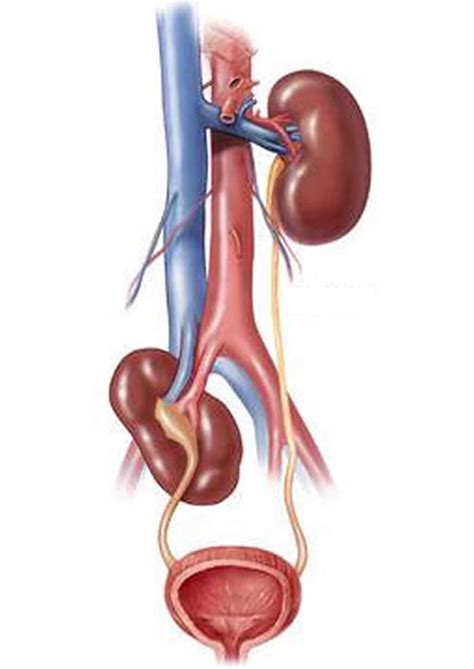 Ectopic kidney, renal ectopia, causes, symptoms, diagnosis & treatment