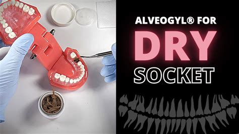 Using Alveogyl To Relieve Dry Socket Pain (Alveolar Osteitis ...