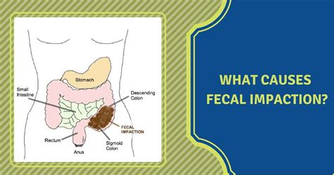 Causes of Faecal Impaction - Dr Maran - Springfield Wellness Centre ...