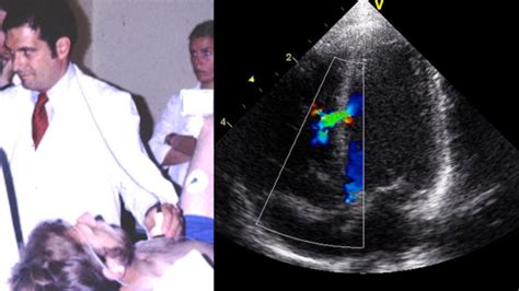 DOPPLER ECHOCARDIOGRAPHY: PAST, PRESENT, AND FUTURE • MyHeart