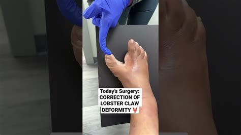 LOBSTER CLAW DEFORMITY 🦞 #shorts #surgery #footsurgery - YouTube