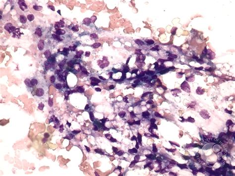 Hypocellular Bone Marrow Following Therapy - 2.