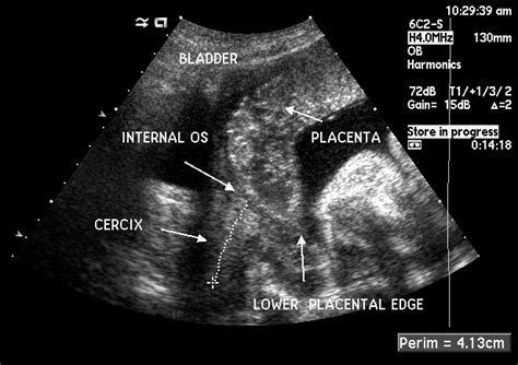 Condition Specific Radiology: Placenta Previa - Stepwards