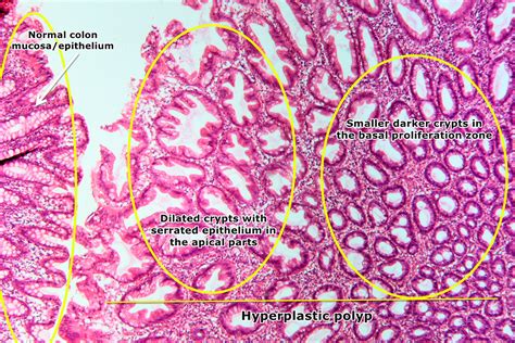 Rectal Polyp Histology