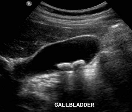 US abdomen (summary) | Radiology Reference Article | Radiopaedia.org