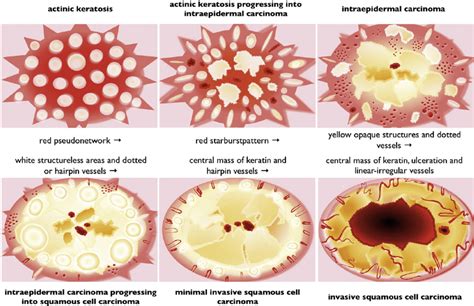 Actinic Keratosis