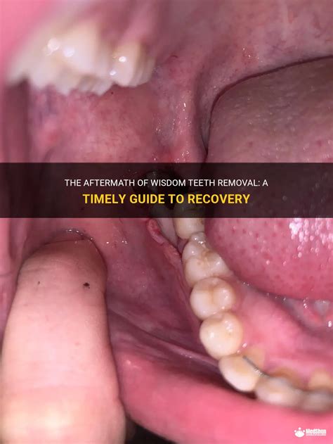 The Aftermath Of Wisdom Teeth Removal: A Timely Guide To Recovery | MedShun