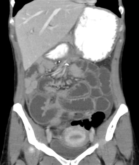 Small Bowel Obstruction | AJR