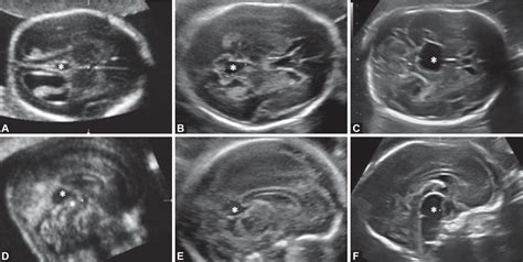 Cavum Velum Interpositum Ultrasound