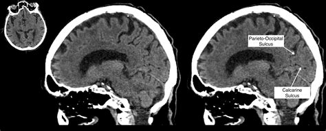 Radiological Anatomy: Calcarine Sulcus - Stepwards