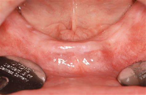 The Edentulous Mandible | Pocket Dentistry