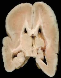 Medical Treatment Pictures-for Better Understanding: Lissencephaly