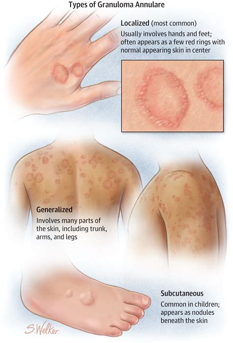 Granuloma Annulare | Granuloma annulare, Dermatology nurse, Medical knowledge