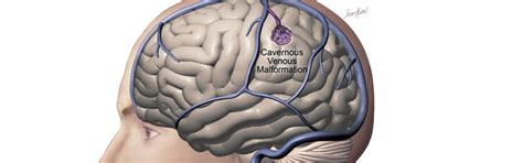 Cavernous Malformation - Neurosurgery