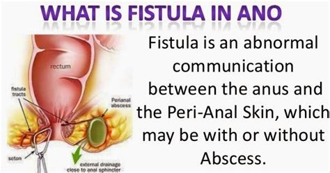 Eeshanayurveda: Ayurveda treatment for fistula in ano