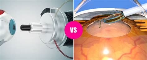 Laser Eye Surgery vs Lens Replacement surgery – What Do You Need to Know?