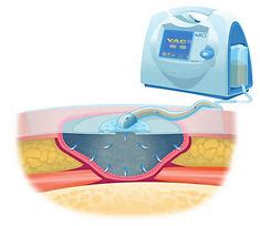 Vacuum Assisted Wound Closure (VAC) | KIH