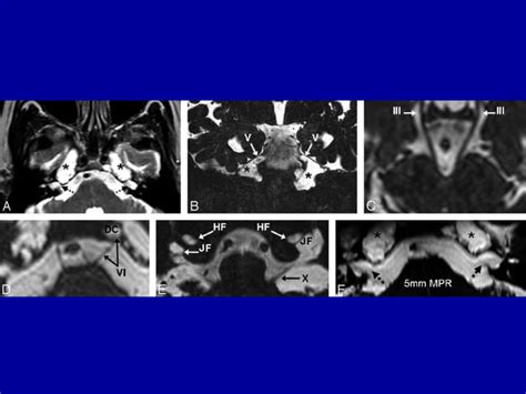 Abducent nerve | PPT