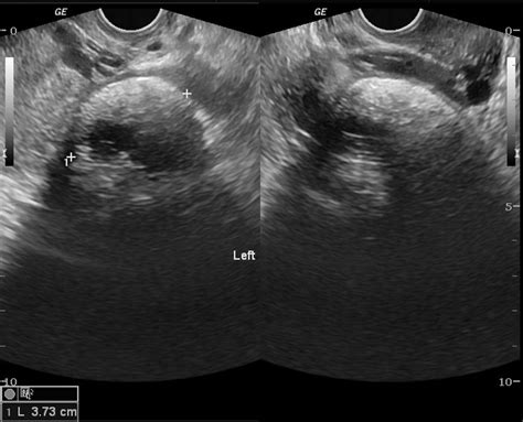 Dermoid cyst ultrasound - wikidoc