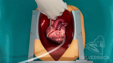 Cardiovascular - Heart Bypass Surgery Procedure - YouTube