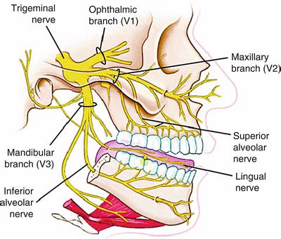 Neural Blockade for Trigeminal Neuralgia | Radiology Key