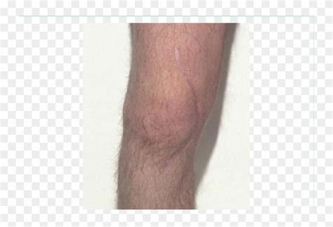 Close-up Of Healed Scar Following Knee Surgery Note - Wood, HD Png ...