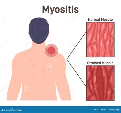 Myositis - Scarlett Seal