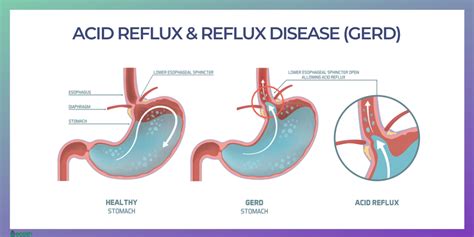 GASTROESOPHAGEAL REFLUX DISEASE (GERD) - Symptoms, Causes, Natural Home ...