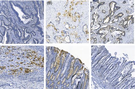 Immunohistochemical staining of HLA‐G in colorectal cancer.... | Download Scientific Diagram