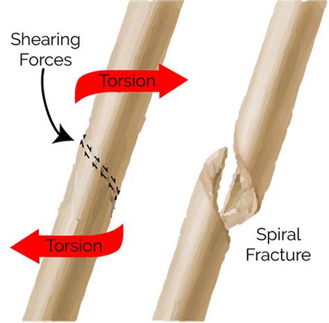 Spiral Fracture of Humerus: Signs, Treatments & Prevention | New Health Advisor