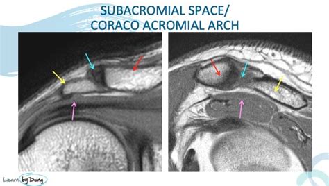 MRI Shoulder Sub Acromial Impingement - Radedasia