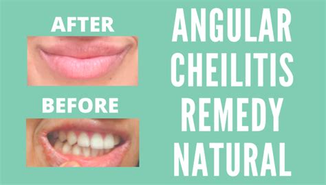 ANGULAR CHEILITIS REMEDY NATURAL – Inner Health Freak