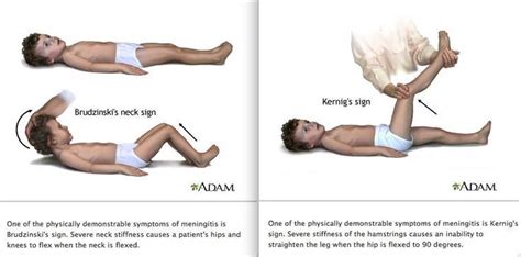 Meningitis signs | Pediatric nursing, Pediatric nurse practitioner ...