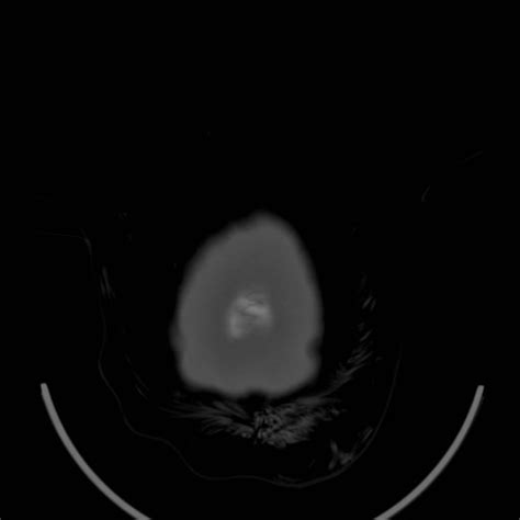 File:Traumatic pneumocranium, cribriform plate fracture and subarachnoid hemorrhage (Radiopaedia ...