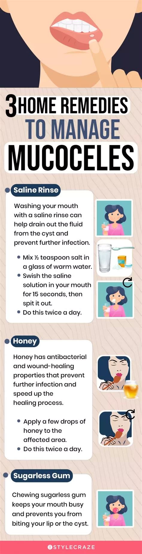 How To Drain A Mucocele Naturally Wound Healing, Healing Process, Saline Rinse, Spit It Out ...