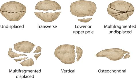 Patella Fracture Classification