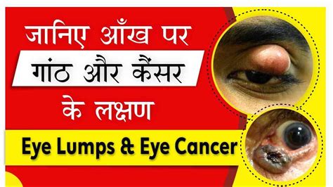 Eyelid Bumps Causes, Treatment & Prevention |Chalazion Treatment | पलक की गांठ का इलाज I Eye ...