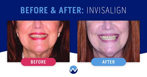 Clear Aligners Before & After: See How They Transform Smiles • Woodhill ...