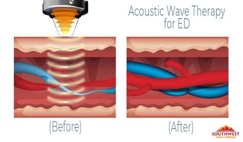 Acoustic Wave Therapy for Erectile Dysfunction | ED Treatment