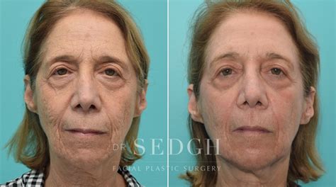 Laser Skin Treatments Before and After Photos | Dr. Sedgh