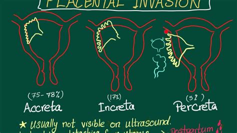 Placenta Accreta Increta And Percreta - tacitceiyrs